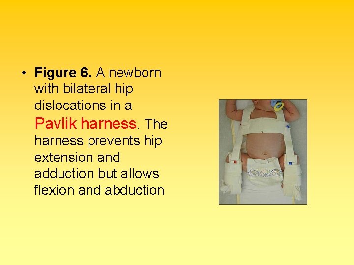  • Figure 6. A newborn with bilateral hip dislocations in a Pavlik harness.