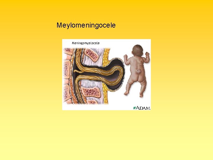 Meylomeningocele 