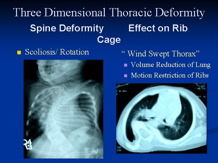Three Dimensional Thoracic Deformity Spine Deformity Effect on Rib Cage n Scoliosis/ Rotation “