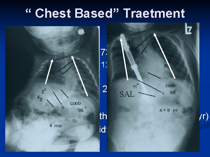 “ Chest Based” Traetment n Avg preop curve n n Avg progression Avg correction