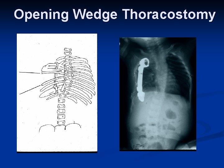 Opening Wedge Thoracostomy 