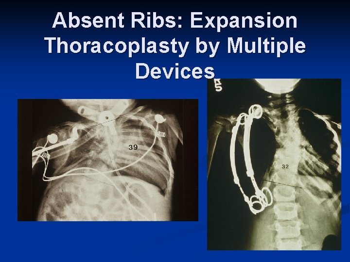 Absent Ribs: Expansion Thoracoplasty by Multiple Devices 