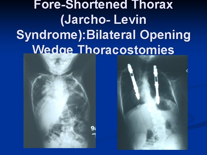 Fore-Shortened Thorax (Jarcho- Levin Syndrome): Bilateral Opening Wedge Thoracostomies 