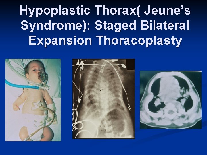 Hypoplastic Thorax( Jeune’s Syndrome): Staged Bilateral Expansion Thoracoplasty 