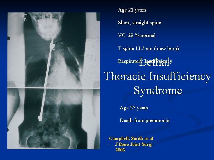 Age 21 years Short, straight spine VC 28 % normal T spine 13. 5