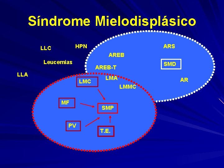Síndrome Mielodisplásico HPN LLC ARS AREB Leucemias LLA LMC MF PV SMD AREB-T LMA