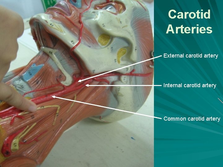 Carotid Arteries External carotid artery Internal carotid artery Common carotid artery 