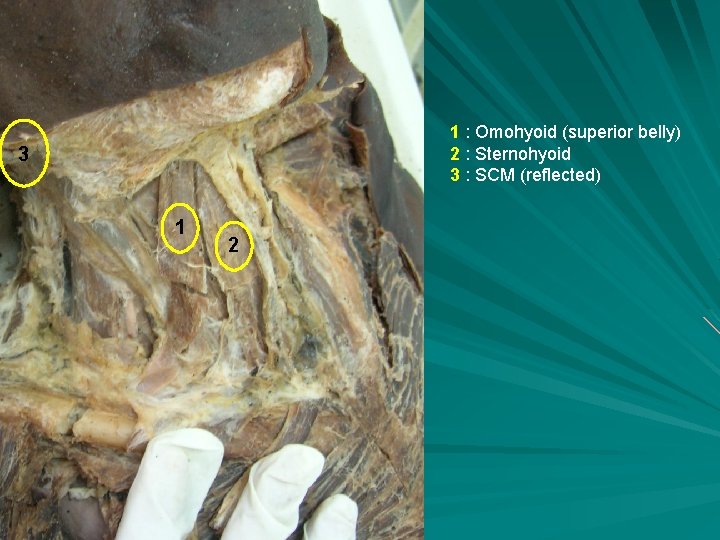 1 : Omohyoid (superior belly) 2 : Sternohyoid 3 : SCM (reflected) 3 1