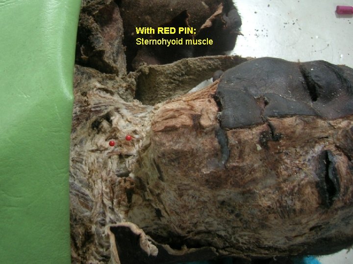 With RED PIN: Sternohyoid muscle 