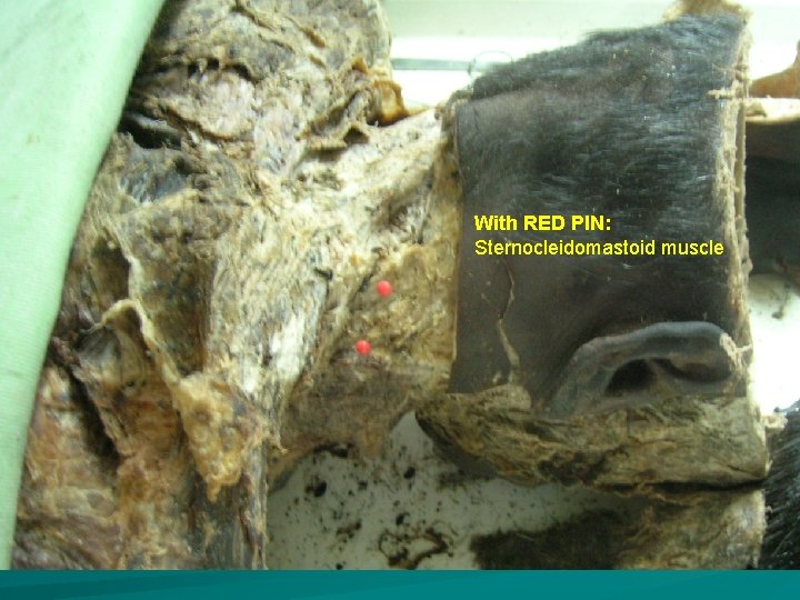 With RED PIN: Sternocleidomastoid muscle 