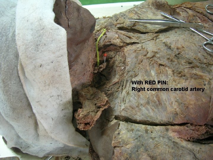 With RED PIN: Right common carotid artery 