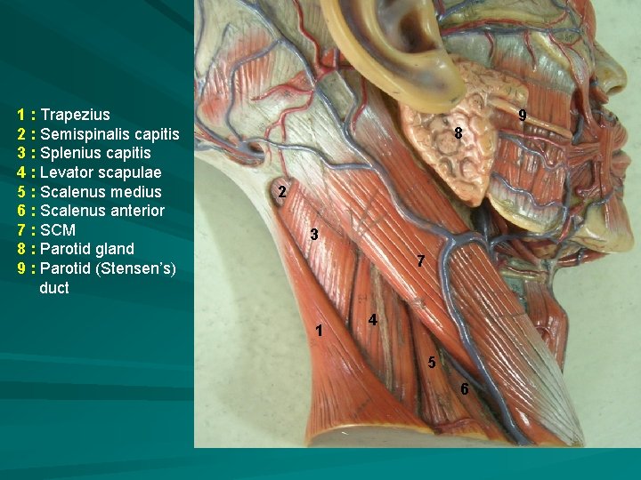 1 : Trapezius 2 : Semispinalis capitis 3 : Splenius capitis 4 : Levator