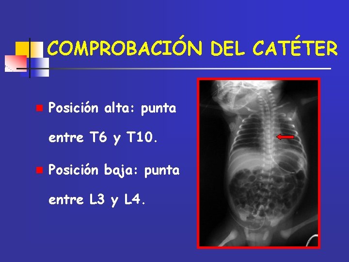 COMPROBACIÓN DEL CATÉTER n Posición alta: punta entre T 6 y T 10. n