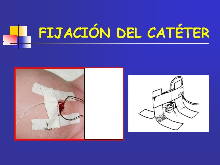 FIJACIÓN DEL CATÉTER 