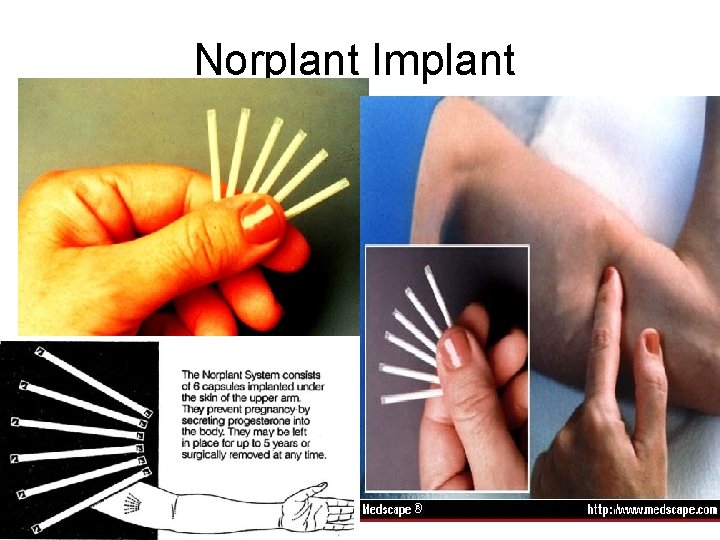 Norplant Implant 