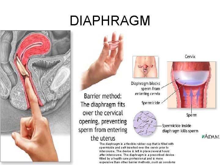 DIAPHRAGM The diaphragm is a flexible rubber cup that is filled with spermicide and