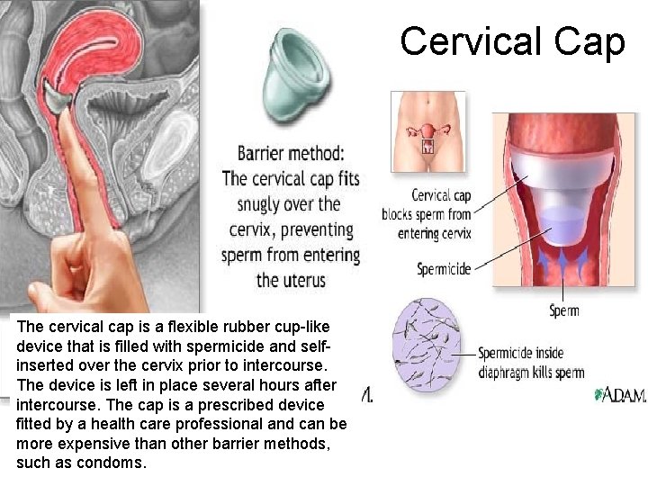 Cervical Cap The cervical cap is a flexible rubber cup-like device that is filled