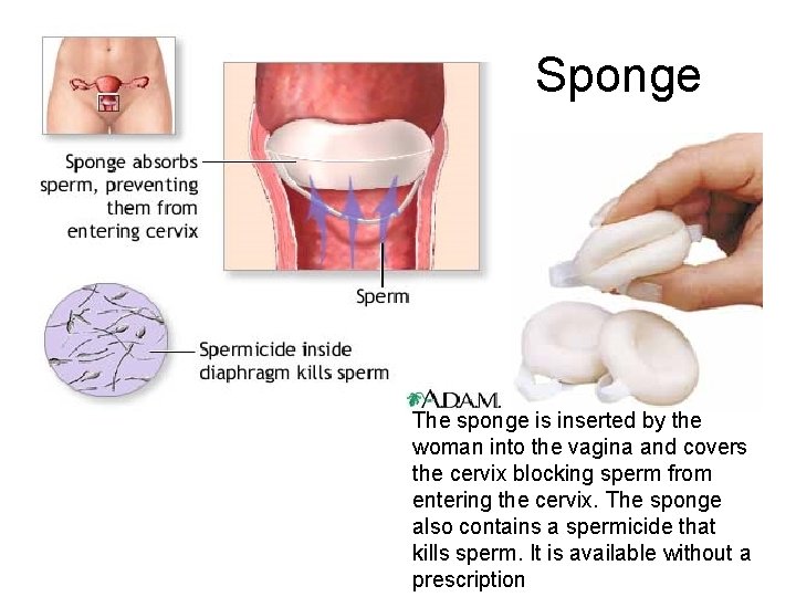 Sponge The sponge is inserted by the woman into the vagina and covers the