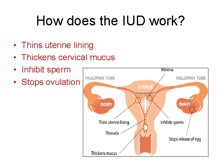 How does the IUD work? • • Thins uterine lining Thickens cervical mucus Inhibit