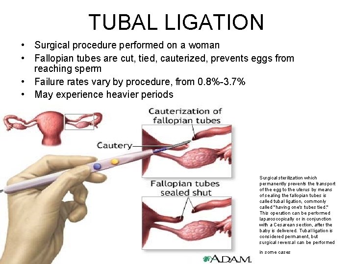 TUBAL LIGATION • Surgical procedure performed on a woman • Fallopian tubes are cut,