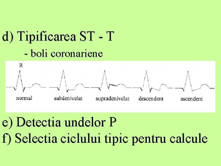 d) Tipificarea ST - boli coronariene e) Detectia undelor P f) Selectia ciclului tipic