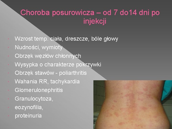 Choroba posurowicza – od 7 do 14 dni po injekcji Wzrost temp. ciała, dreszcze,