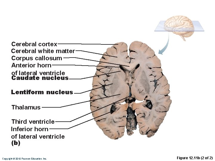 Cerebral cortex Cerebral white matter Corpus callosum Anterior horn of lateral ventricle Caudate nucleus