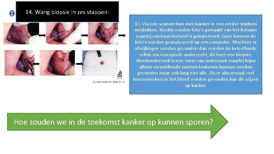 14. Wang biopsie in zes stappen. 13. Via een scanner kan men kanker in