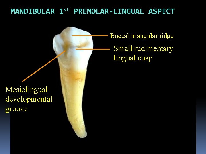 MANDIBULAR 1 st PREMOLAR-LINGUAL ASPECT Buccal triangular ridge Small rudimentary lingual cusp Mesiolingual developmental