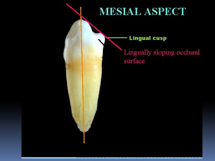 MESIAL ASPECT Lingual cusp Lingually sloping occlusal surface Mesiolingual developmental groove 