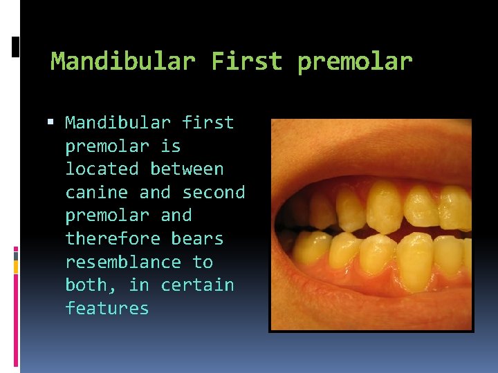 Mandibular First premolar Mandibular first premolar is located between canine and second premolar and