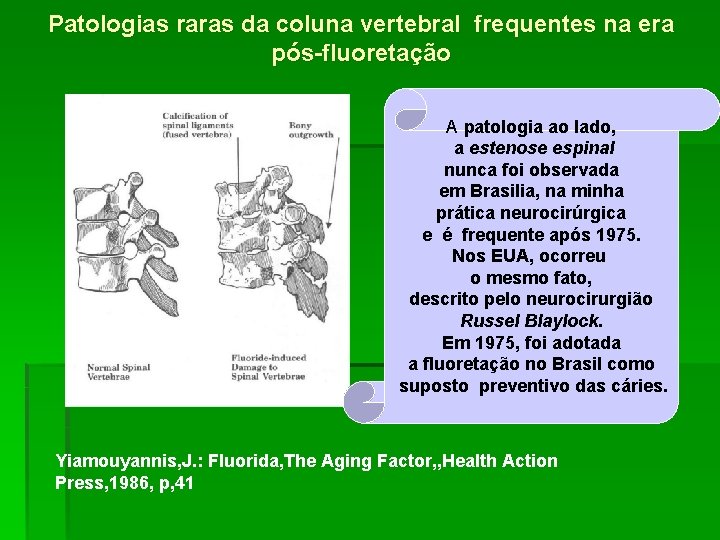 Patologias raras da coluna vertebral frequentes na era pós-fluoretação A patologia ao lado, a