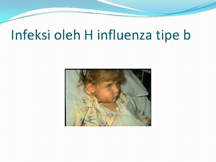 Infeksi oleh H influenza tipe b 