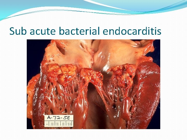 Sub acute bacterial endocarditis 