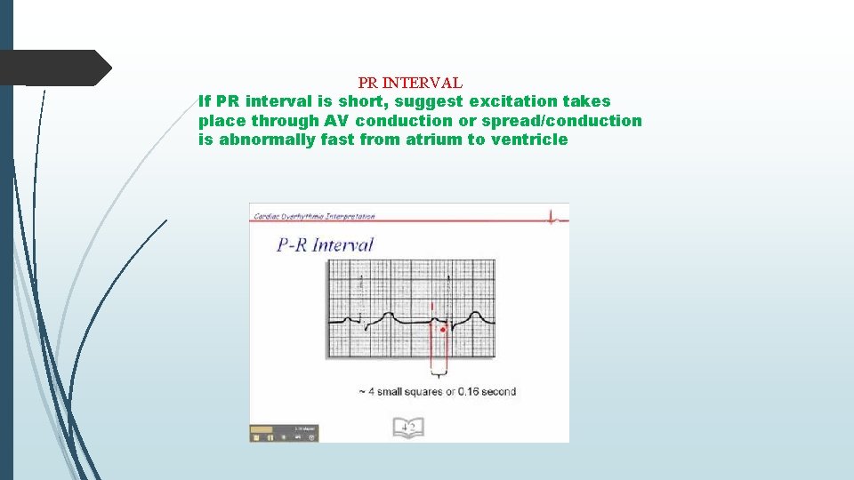 PR INTERVAL If PR interval is short, suggest excitation takes place through AV conduction