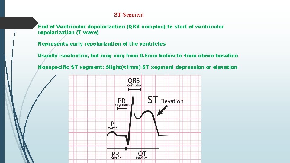 ST Segment End of Ventricular depolarization (QRS complex) to start of ventricular repolarization (T