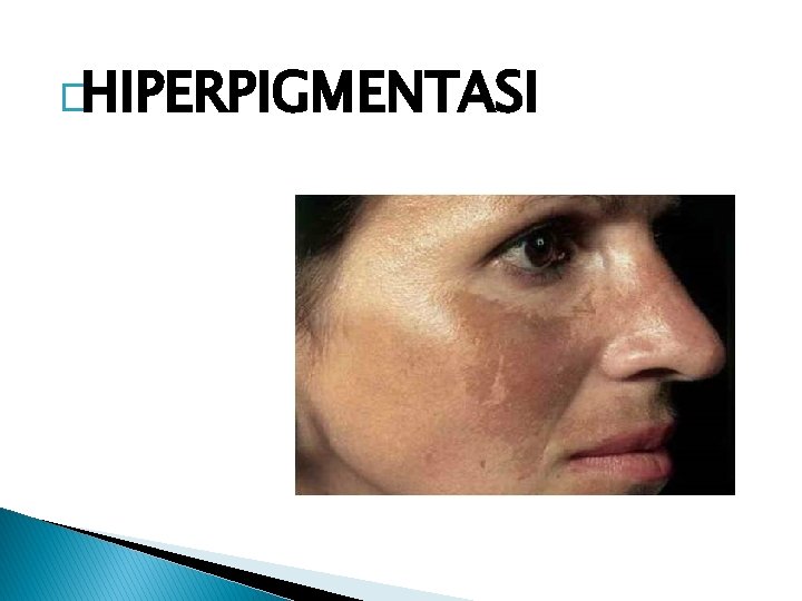 �HIPERPIGMENTASI 