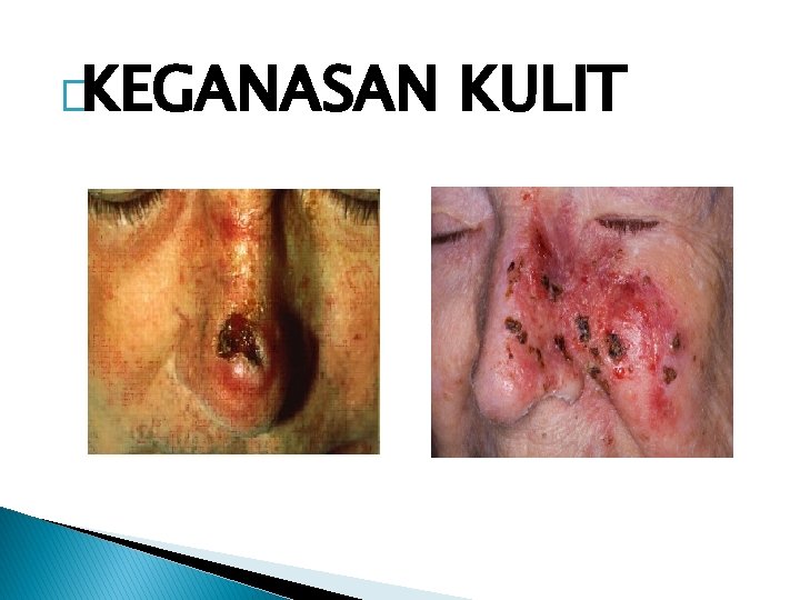 �KEGANASAN KULIT 