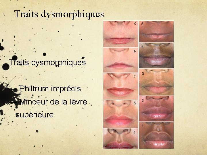 Traits dysmorphiques — Philtrum imprécis — Minceur de la lèvre supérieure 