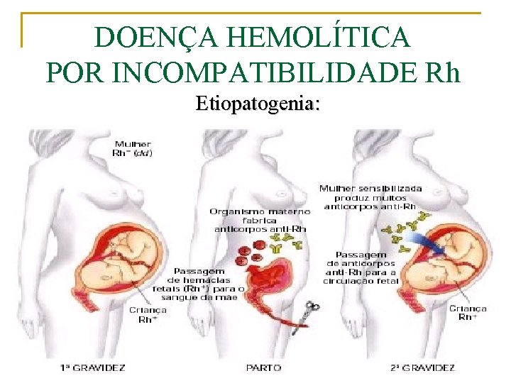 DOENÇA HEMOLÍTICA POR INCOMPATIBILIDADE Rh Etiopatogenia: 