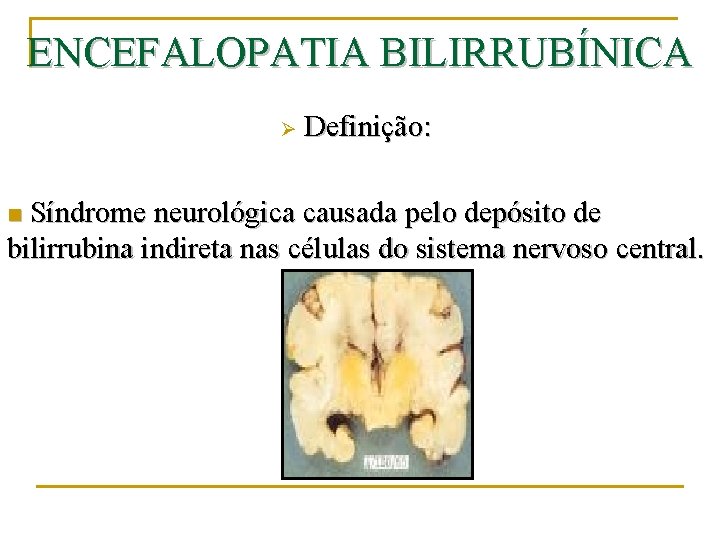 ENCEFALOPATIA BILIRRUBÍNICA Ø Definição: Síndrome neurológica causada pelo depósito de bilirrubina indireta nas células