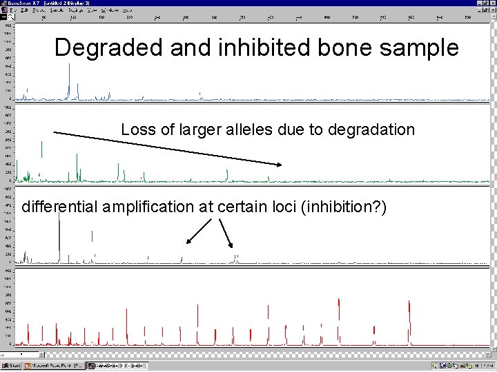 Degraded and inhibited bone sample Loss of larger alleles due to degradation differential amplification
