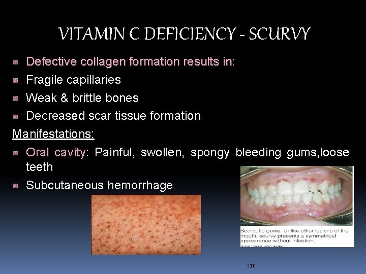 VITAMIN C DEFICIENCY - SCURVY Defective collagen formation results in: Fragile capillaries Weak &