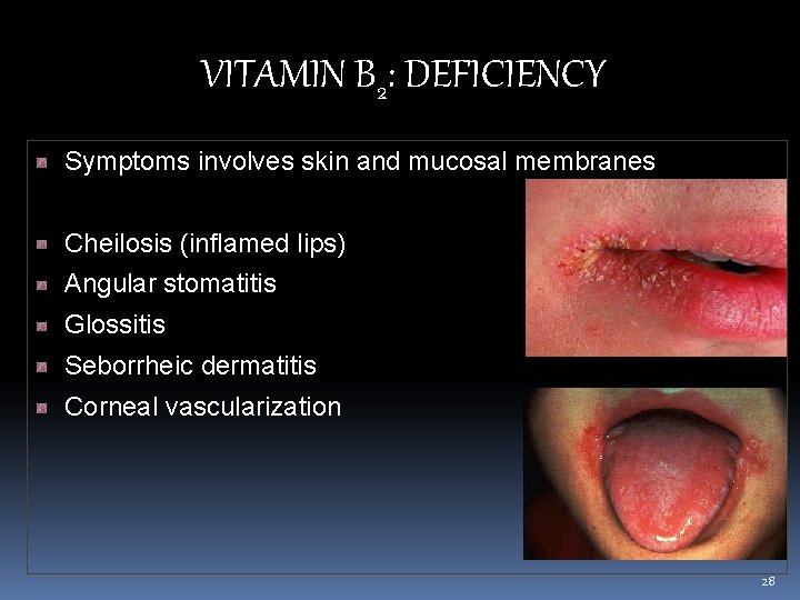 VITAMIN B 2: DEFICIENCY Symptoms involves skin and mucosal membranes Cheilosis (inflamed lips) Angular