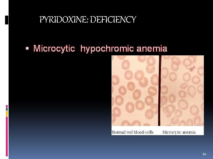 PYRIDOXINE: DEFICIENCY Microcytic hypochromic anemia 60 