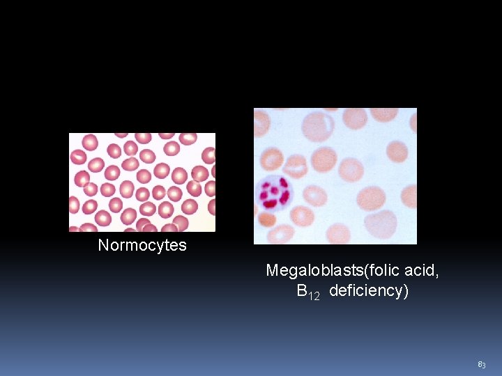 Blood picture in anemia Normocytes Megaloblasts(folic acid, B 12 deficiency) 83 