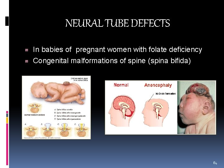 NEURAL TUBE DEFECTS In babies of pregnant women with folate deficiency Congenital malformations of