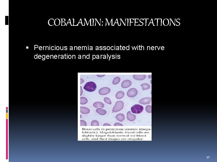 COBALAMIN: MANIFESTATIONS Pernicious anemia associated with nerve degeneration and paralysis 97 