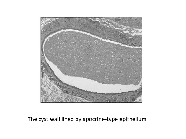 The cyst wall lined by apocrine-type epithelium 