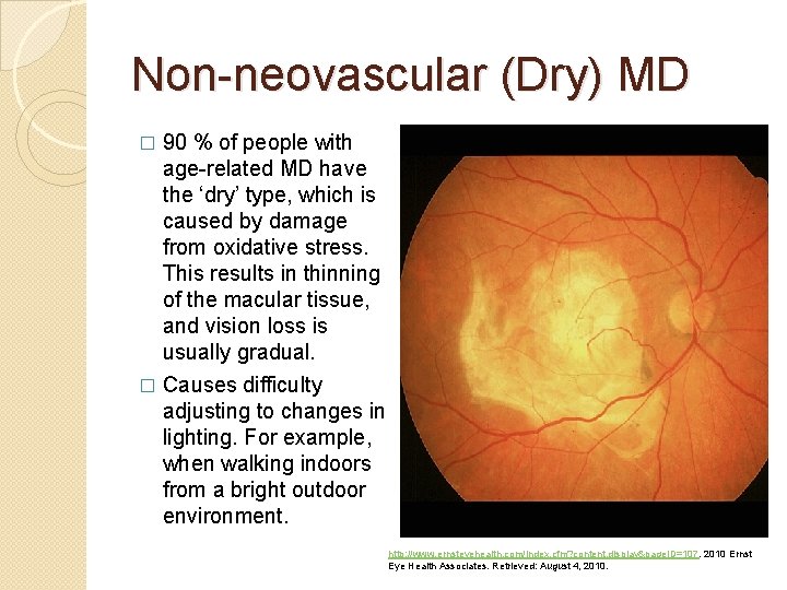 Non-neovascular (Dry) MD 90 % of people with age-related MD have the ‘dry’ type,